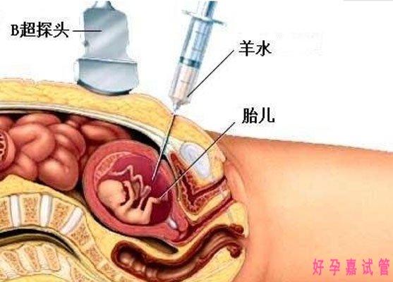 羊水穿刺在B超下进行操作