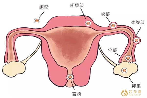 宫外孕是什么症状？什么原因造成的