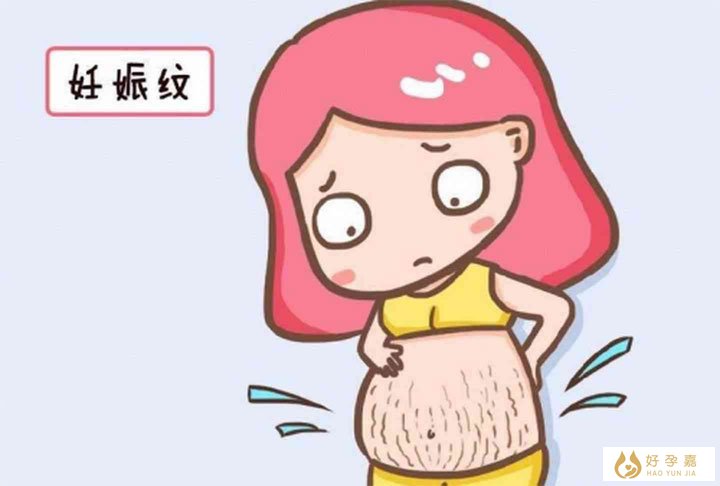 妊娠纹